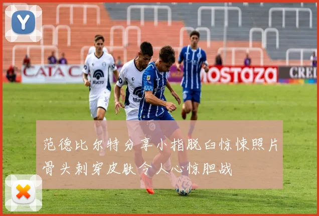 范德比尔特分享小指脱臼惊悚照片骨头刺穿皮肤令人心惊胆战